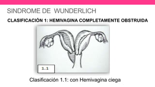 SINDROME DE WUNDERLICH
•
CLASIFICACIÓN 1: HEMIVAGINA COMPLETAMENTE OBSTRUIDA
Clasificación 1.1: con Hemivagina ciega
 