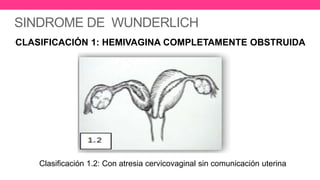 SINDROME DE WUNDERLICH
•
CLASIFICACIÓN 1: HEMIVAGINA COMPLETAMENTE OBSTRUIDA
Clasificación 1.2: Con atresia cervicovaginal sin comunicación uterina
 