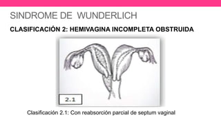 SINDROME DE WUNDERLICH
CLASIFICACIÓN 2: HEMIVAGINA INCOMPLETA OBSTRUIDA
Clasificación 2.1: Con reabsorción parcial de septum vaginal
 