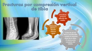 Caída de pie de
altura considerable
= estalla el extremo
distal de la tibia,
 destrucción
completa del
tobillo.
Reducción
abierta +
fijación
interna
rígida
artrodesis
primaria
diferida del
tobillo.
JMGM - TRAUMATOLOGIA - CEMAIN
 