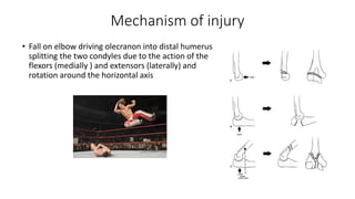 Fractures around elbow lateral condyle and intercondylar fractures | PDF