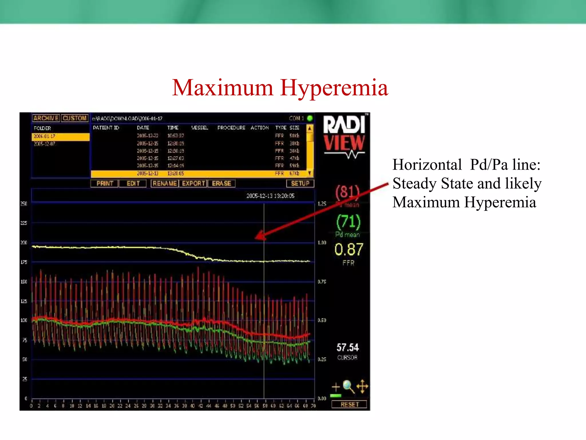 Maximum Hyperemia
Horizontal Pd/Pa line:
Steady State and likely
Maximum Hyperemia
 
