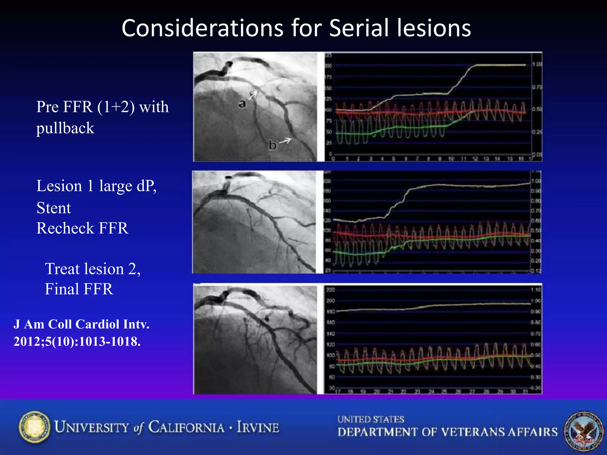Treat lesion 2,
Final FFR
J Am Coll Cardiol Intv.
2012;5(10):1013-1018.
Considerations for Serial lesions
Pre FFR (1+2) with
pullback
Lesion 1 large dP,
Stent
Recheck FFR
 