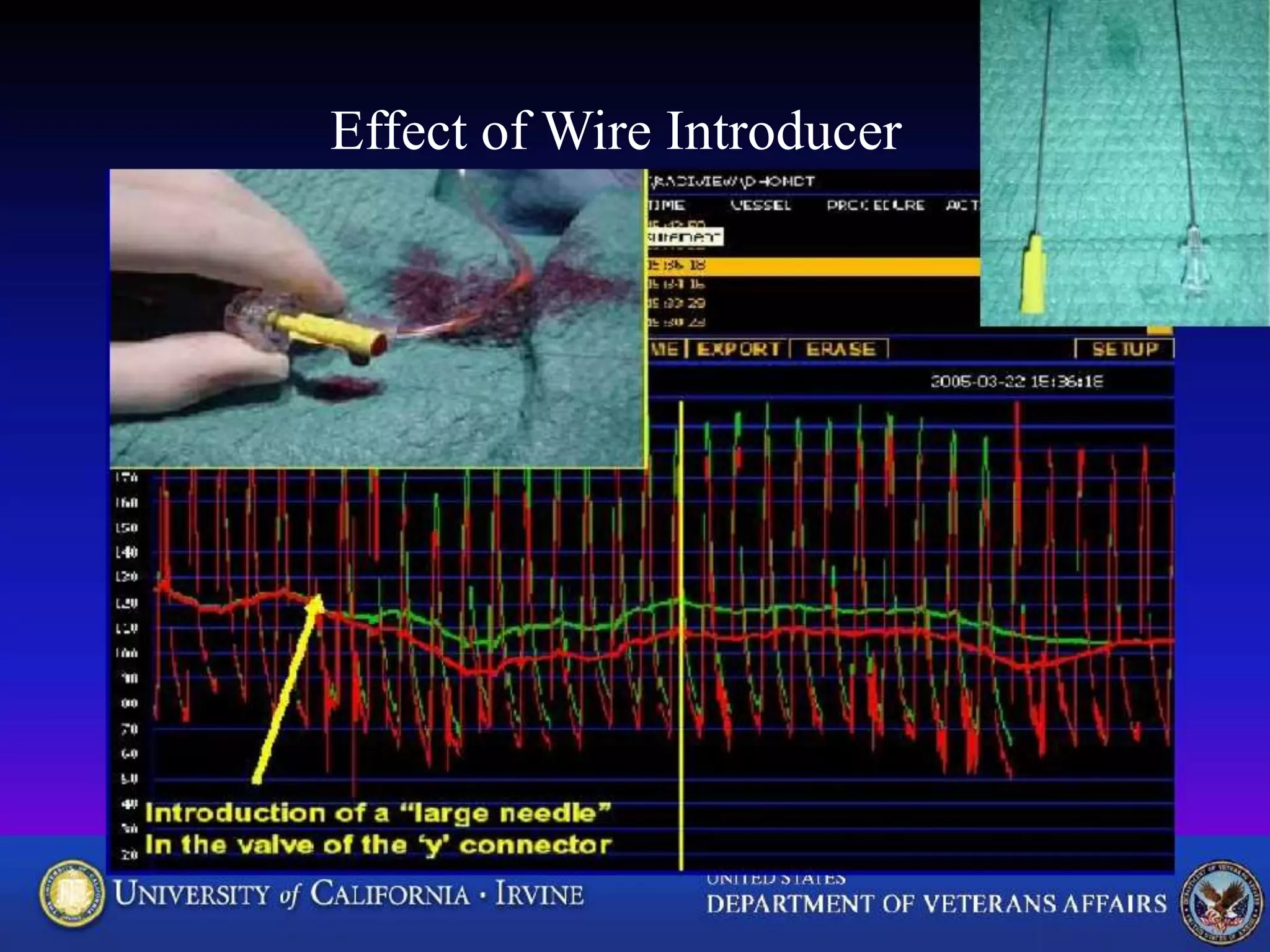Effect of Wire Introducer
 
