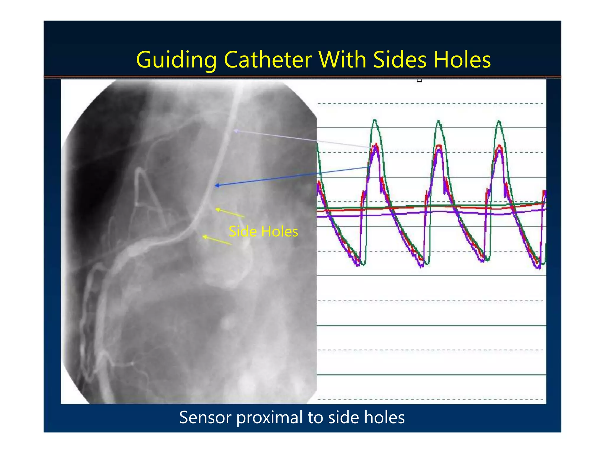 Side Holes
Sensor proximal to side holes
Guiding Catheter With Sides Holes
 
