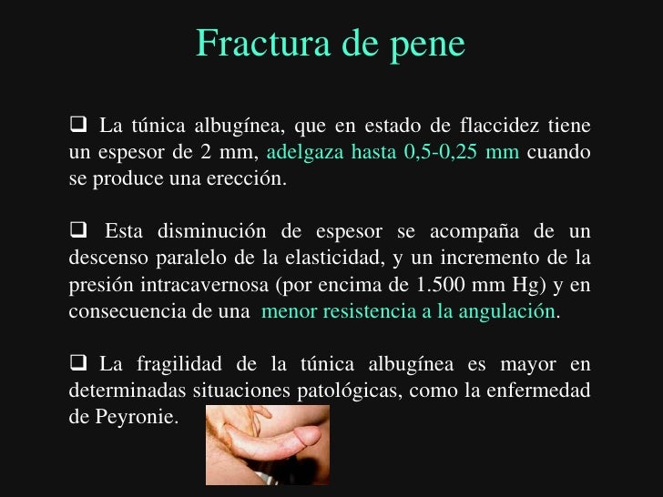 Sin operación ha aumentado el miembro