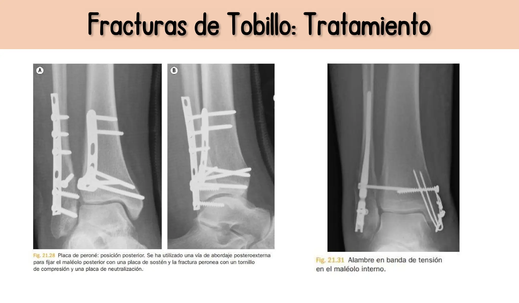 Presentación de fractura-de-tobillo en medicina | PPTX
