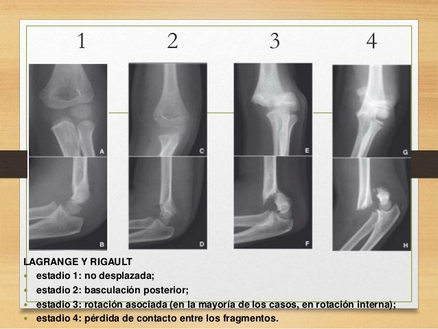 Fractura supracondílea humero niños