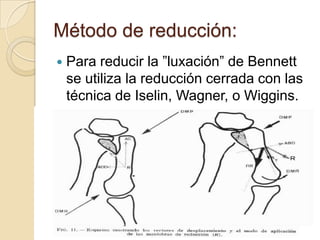 Método de reducción:
   Para reducir la ”luxación” de Bennett
    se utiliza la reducción cerrada con las
    técnica de Iselin, Wagner, o Wiggins.
 