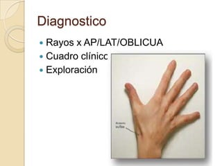Diagnostico
 Rayos x AP/LAT/OBLICUA
 Cuadro clínico
 Exploración
 