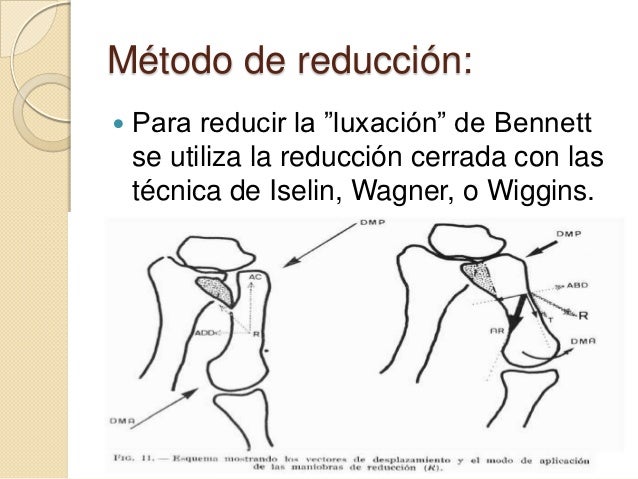 Fractura
