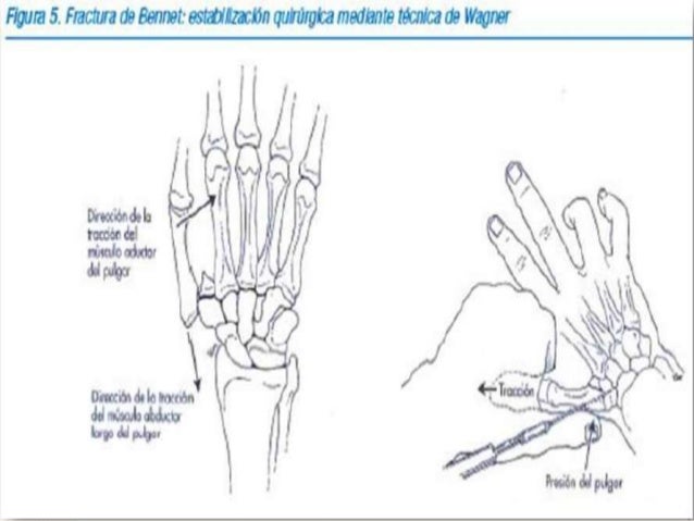 Fractura