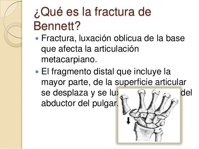 Fractura