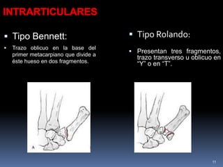 11
 Tipo Bennett:
 Trazo oblicuo en la base del
primer metacarpiano que divide a
éste hueso en dos fragmentos.
 Presentan tres fragmentos,
trazo transverso u oblicuo en
“Y” o en “T”.
 Tipo Rolando:
 