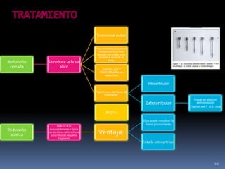 16
ACD-2
Reducción
cerrada
Se reduce la fx sin
abrir
Tracciona el pulgar
Yeso antebraquiopalmar
incluyendo la primer
falange del pulgar y se
modela a nivel de la
base.
(VENDAJES Y
FISIOTERAPIA sin
reducción)
Fijación con alambres de
Kirschener
Intraarticular
Extraarticular
Pulgar en abd con
semioposición
Fijacion del 1 al 2 mcp
Reducción
abierta
Reducir la fx
quirurgicamente y fijarla
con alambres de Kirschener
o tornillos de pequeño
fragmento
Ventaja:
El px puede movilizar la
mano precozmente
Evita la osteoartrosis
 