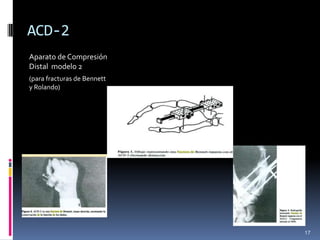 ACD-2
Aparato de Compresión
Distal modelo 2
(para fracturas de Bennett
y Rolando)
17
 