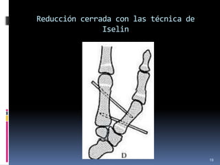 Reducción cerrada con las técnica de
Iselin
19
 