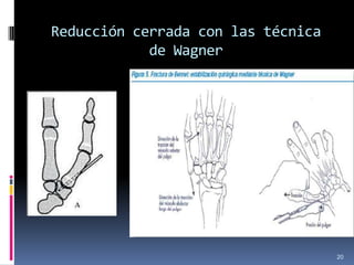 Reducción cerrada con las técnica
de Wagner
20
 