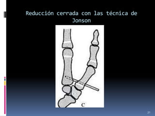 Reducción cerrada con las técnica de
Jonson
21
 