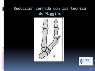 Reducción cerrada con las técnica
de Wiggins
22
 