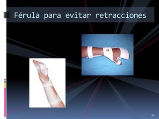 33
Férula para evitar retracciones
 