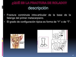 descripción
• Fractura conminuta intra-articular de la base de la
falange del primer metacarpiano.
• El grado de configuración típica es forma de “Y” o de “T”.
43
 