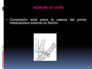 • Compresión axial sobre la cabeza del primer
metacarpiano estando en flexión.
46
 