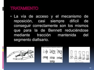 • La vía de acceso y el mecanismo de
reposición, casi siempre difícil de
conseguir correctamente son los mismos
que para la de Bennett reduciéndose
mediante tracción mantenida del
segmento diafisario.
50
 