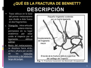  Trazo oblicuo en la base
del primer metacarpiano
que divide a éste hueso
en dos fragmentos:
1. Triangular, intra-articular
y antero-interno,
permanece en su lugar
anatómico por estar
unido al trapecio por el
ligamento oblicuo
palmar.
2. Resto del metacarpiano,
se desplaza hacia atrás,
arriba y afuera por acción
de los músculos
extensores y del abductor
largo del pulgar.
8
 