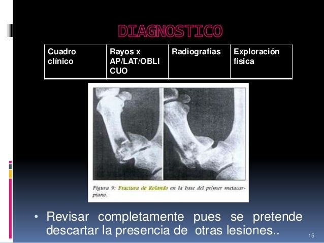 Fractura rolando