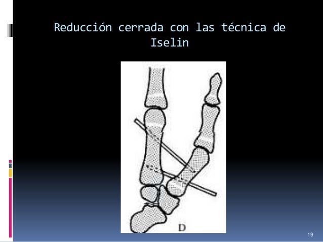 Fractura rolando