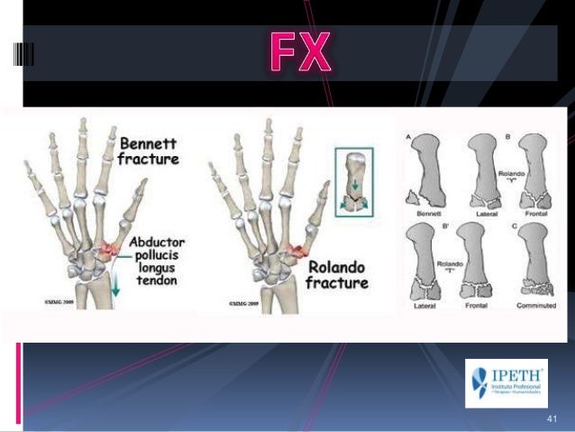 Fractura rolando