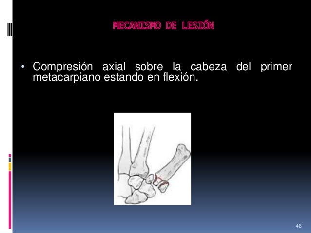 Fractura rolando