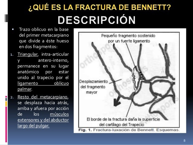 Fractura rolando