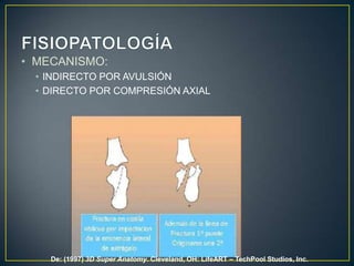 FISIOPATOLOGÍAMECANISMO:INDIRECTO POR AVULSIÓNDIRECTO POR COMPRESIÓN AXIALDe: (1997) 3DSuper Anatomy. Cleveland, OH: LifeART – TechPool Studios, Inc.