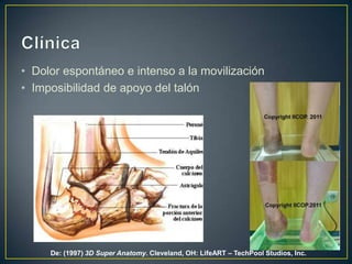ClínicaDolor espontáneo e intenso a la movilizaciónImposibilidad de apoyo del talónDe: (1997) 3DSuper Anatomy. Cleveland, OH: LifeART – TechPool Studios, Inc.
