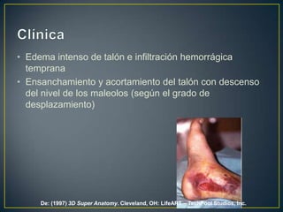 Clínica Edema intenso de talón e infiltración hemorrágica tempranaEnsanchamiento y acortamiento del talón con descenso del nivel de los maleolos (según el grado de desplazamiento)De: (1997) 3DSuper Anatomy. Cleveland, OH: LifeART – TechPool Studios, Inc.
