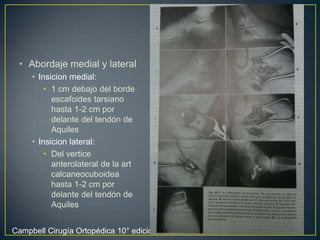 Abordaje medial y lateral Insicion medial:1 cm debajo del borde escafoides tarsiano hasta 1-2 cm por delante del tendón de Aquiles Insicion lateral:Del verticeanterolateral de la art calcaneocuboidea hasta 1-2 cm por delante del tendón de Aquiles Campbell Cirugía Ortopédica 10° edición vól. IV