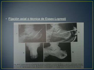 Fijación axial o técnica de Essex-Lopresti