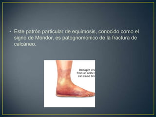 Este patrón particular de equimosis, conocido como el signo de Mondor, es patognomónico de la fractura de calcáneo. 