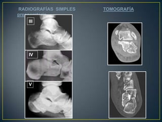 IIIIVVRADIOGRAFÍASSIMPLES 		    TOMOGRAFÍApreoperatoria