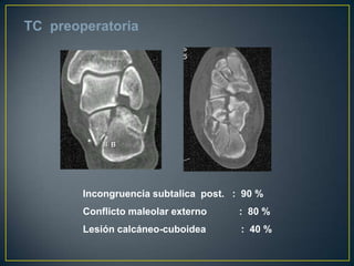 II  BTC  preoperatoriaIncongruencia subtalica  post.   :  90 %Conflicto maleolar externo            :  80 %Lesión calcáneo-cuboidea             :  40 %  