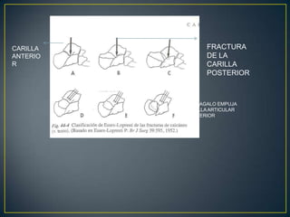 FRACTURA DE LA CARILLA POSTERIORCARILLA ANTERIORASTRAGALO EMPUJA CARILLA ARTICULAR POSTERIOR