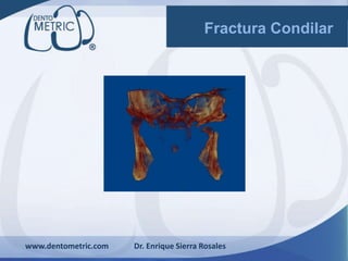 www.dentometric.com Dr. Enrique Sierra Rosales
Fractura Condilar
 