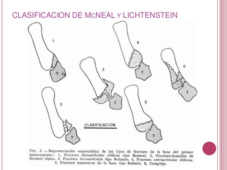 Si duele el cuello a las enfermedades de la glándula tiroides