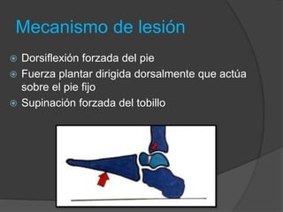 Mecanismo de lesión
 Dorsiflexión forzada del pie
 Fuerza plantar dirigida dorsalmente que actúa
sobre el pie fijo
 Supinación forzada del tobillo
 