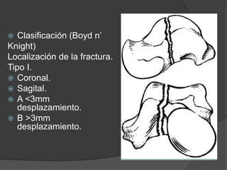  Clasificación (Boyd n’
Knight)
Localización de la fractura.
Tipo I.
 Coronal.
 Sagital.
 A <3mm
desplazamiento.
 B >3mm
desplazamiento.
 