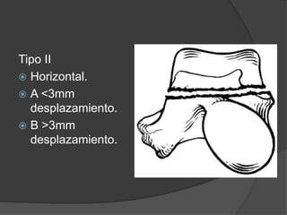 Tipo II
 Horizontal.
 A <3mm
desplazamiento.
 B >3mm
desplazamiento.
 