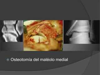  Osteotomía del maléolo medial
 