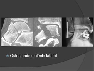  Osteotomía maléolo lateral
 